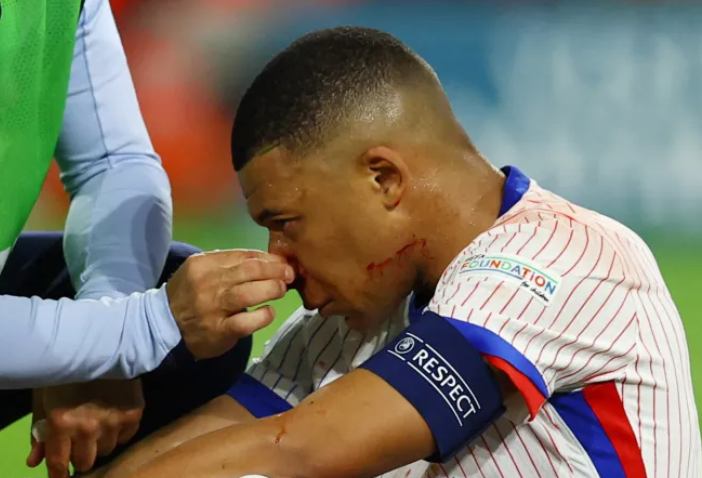 Đội trưởng Les Bleus tỏ ra khá đau đớn và theo dự kiến, anh có thể phải vắng mặt cho đến hết vòng bảng EURO 2024.