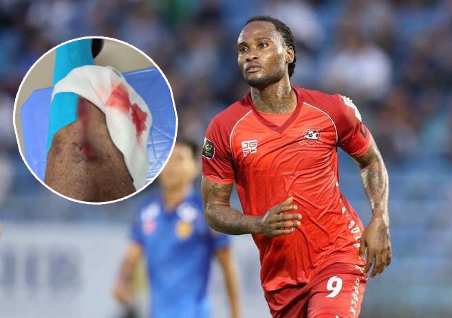 Ảnh bài viết SỐC! Va chạm với đồng đội, ngoại binh Hải Phòng chấn thương nặng